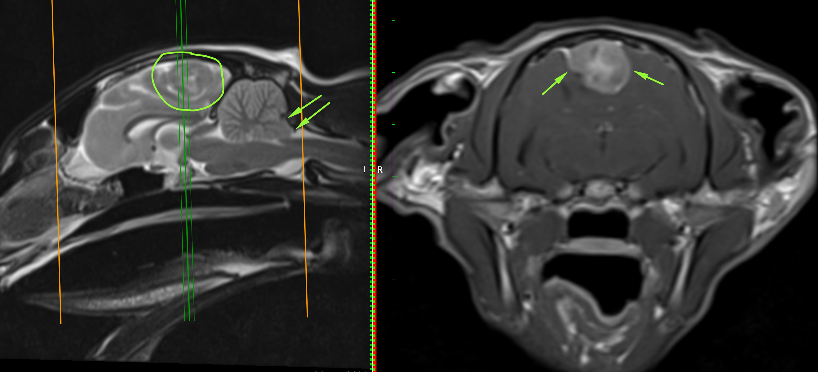 Surgeons at Bridge Referrals perform a Craniectomy in the successful treatment of a meningioma brain tumour