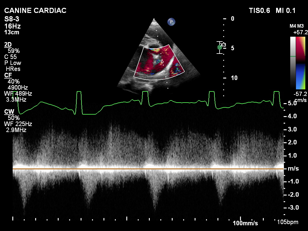 Treating A PDA when interventional methods are not available