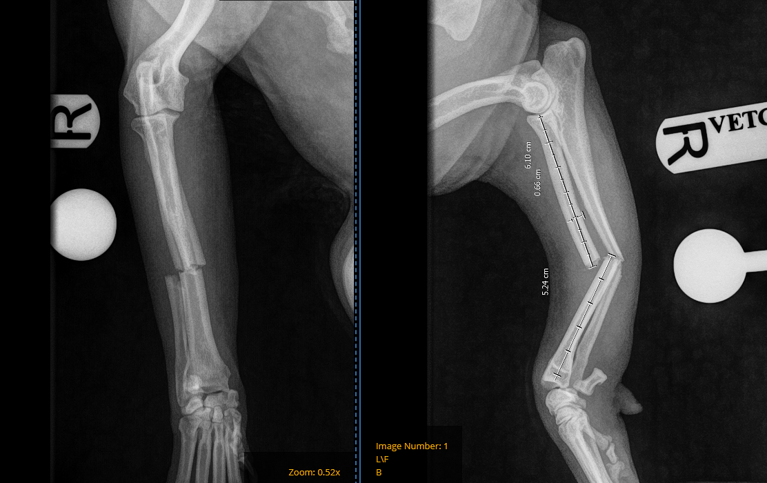 Jill’s Journey: Bouncing Back After a Broken Leg