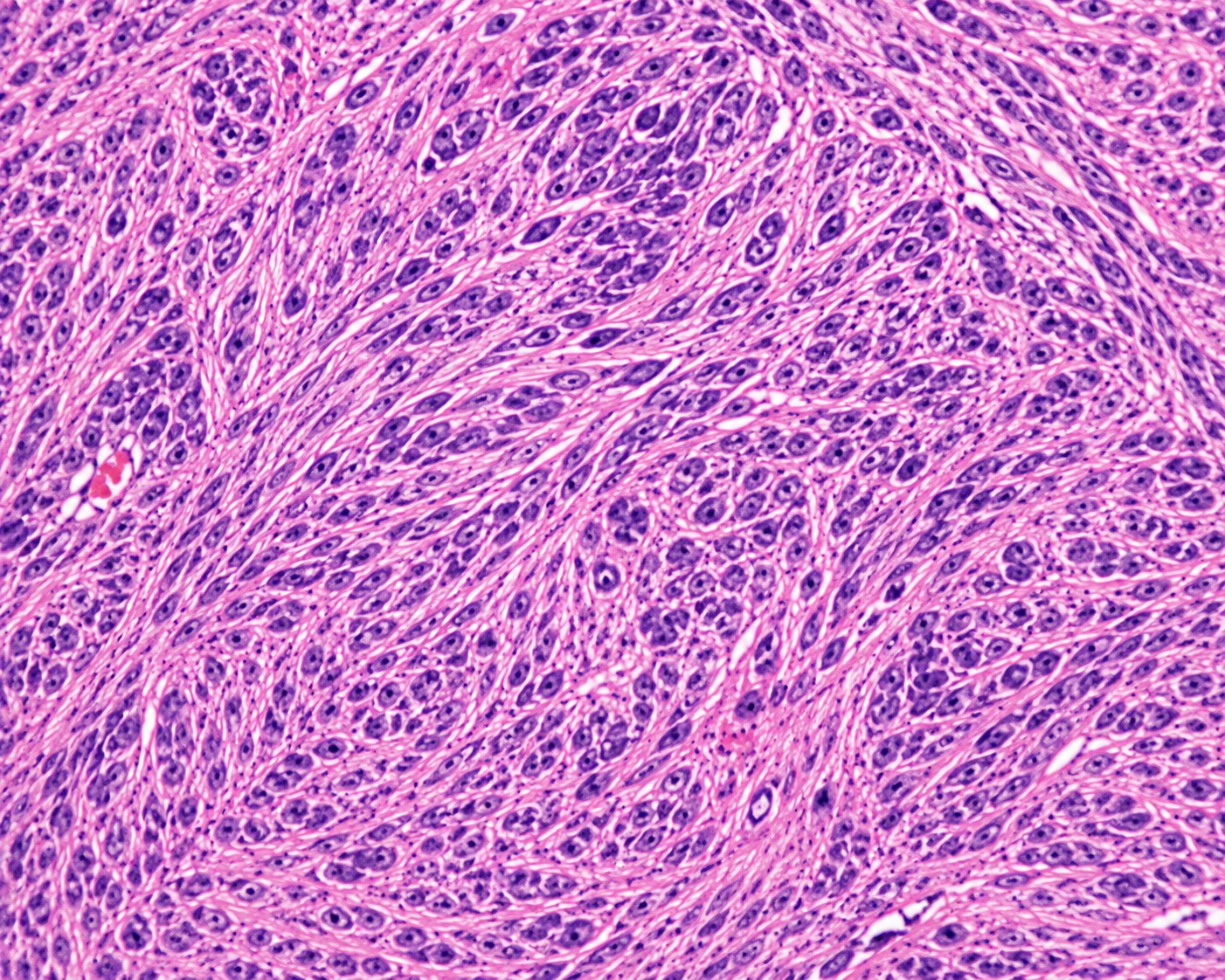 Sarcoma Awareness Month: What is a Sarcoma and Why Does Early Referral Matter?